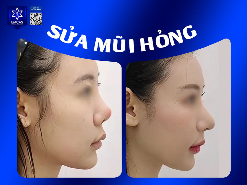 Việc hiểu rõ nguyên nhân dẫn đến bao xơ vùng mũi là bước quan trọng để phòng ngừa xử lý, giảm thiểu rủi ro và duy trì dáng mũi tự nhiên, mềm mại sau nâng.