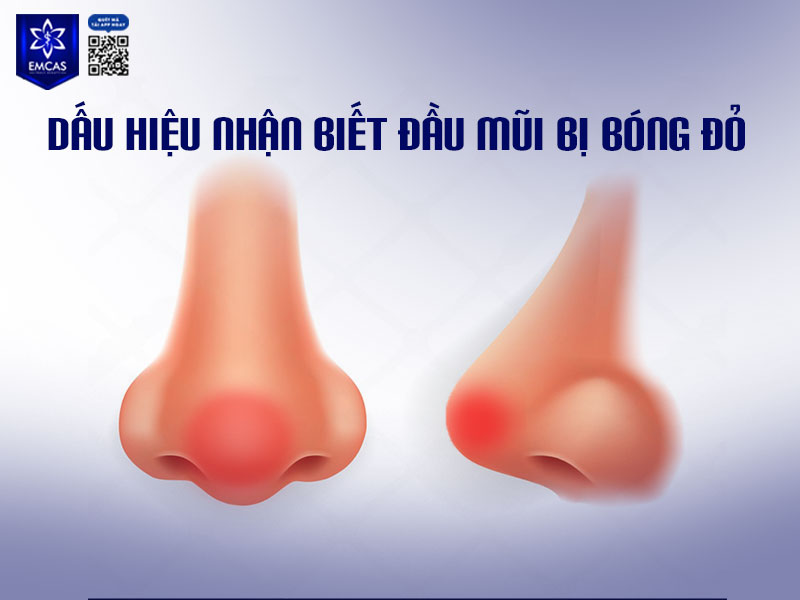 Nâng mũi bị bóng đỏ đầu mũi là một hiện tượng không xuất hiện đột ngột mà phát triển theo thời gian.