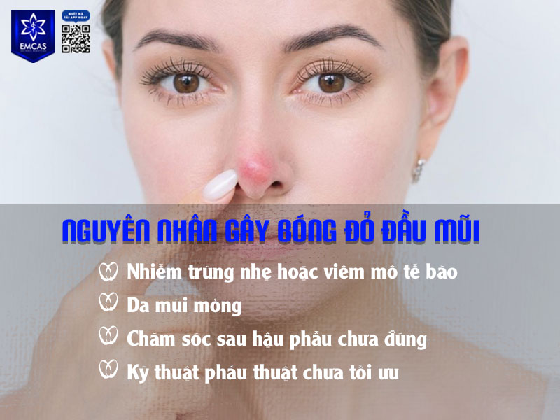 Tình trạng đầu mũi bị bóng đỏ thường xuất phát từ sự tương tác bất thường giữa chất liệu nâng mũi và các mô mềm ở đầu mũi.