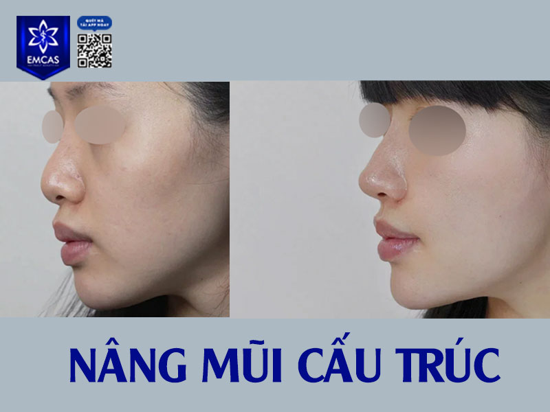 Mũi hếch với đặc điểm phần đầu mũi hướng lên cao, lộ rõ lỗ mũi khi nhìn chính diện, khiến gương mặt kém thanh thoát