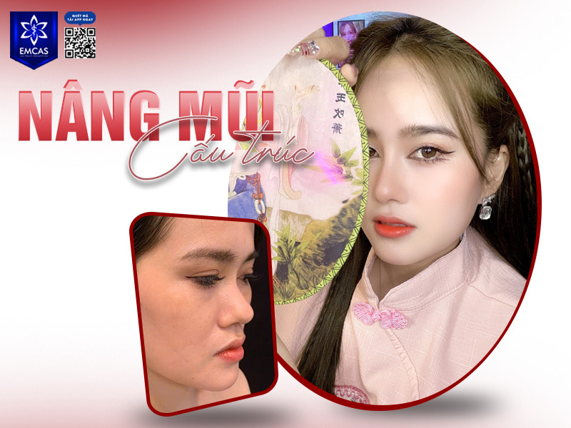 Phẫu thuật nâng mũi là thủ thuật can thiệp vào phần sụn và xương của mũi, chủ yếu ở sống mũi, đầu mũi và vách ngăn nhằm cải thiện dáng mũi và tỷ lệ khuôn mặt.