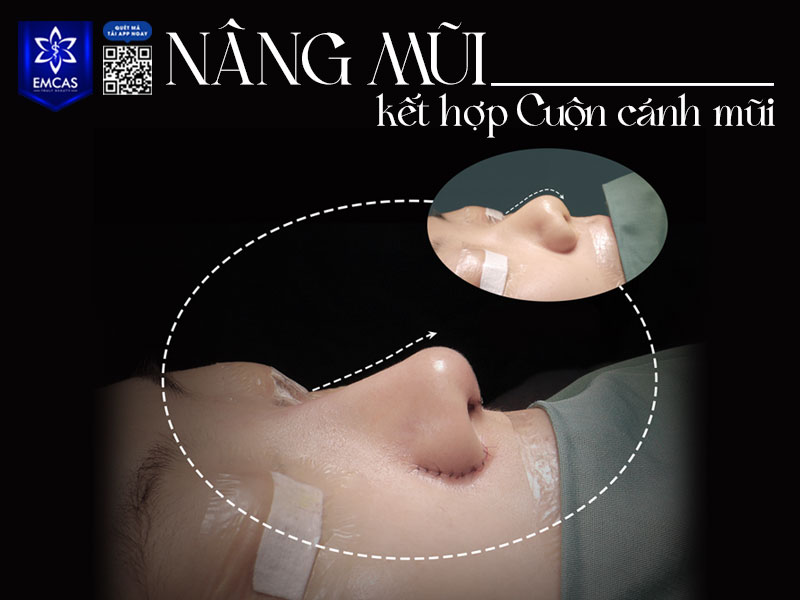 Chi phí cuộn cánh mũi còn tùy thuộc vào nhiều yếu tố như tình trạng mũi ban đầu, kỹ thuật thực hiện, tay nghề bác sĩ và cơ sở thẩm mỹ mà bạn lựa chọn.