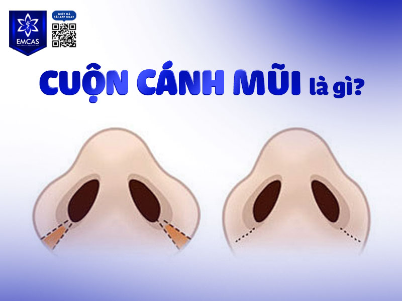 Cuộn cánh mũi được thực hiện bằng cách bác sĩ rạch một đường nhỏ trong hốc mũi, sau đó khéo léo cuộn phần mô mềm ở chân cánh mũi vào bên trong và khâu cố định lại