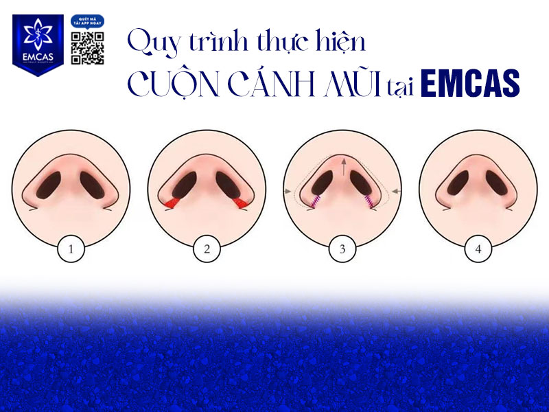 Tại Bệnh Viện Thẩm Mỹ EMCAS, tiểu phẫu cuộn cánh mũi được diễn ra theo quy trình y khoa an toàn giúp mang lại kết quả thẩm mỹ tối ưu.