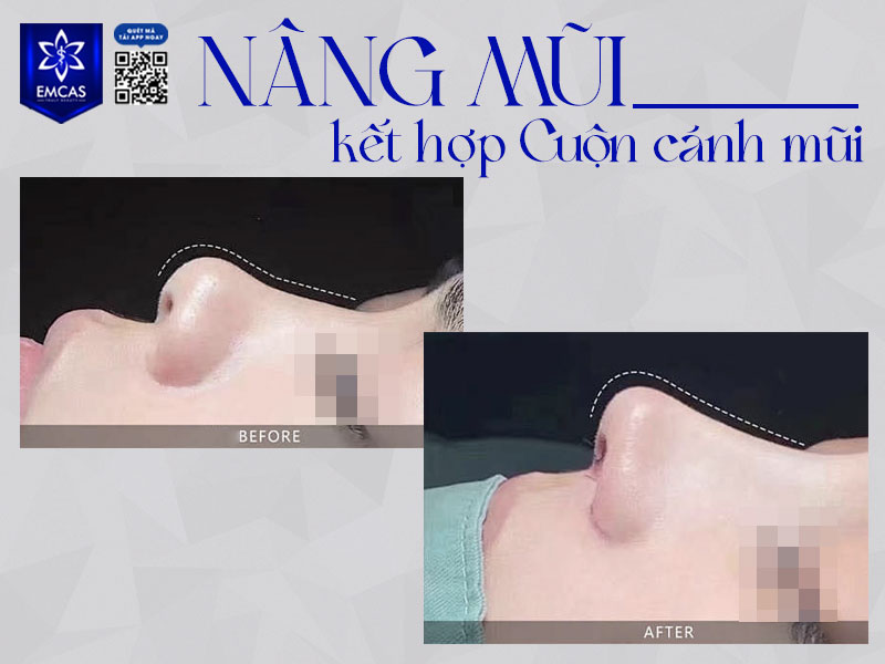 Cuộn cánh mũi là kỹ thuật được đánh giá cao nhờ khả năng cải thiện dáng mũi nhanh chóng, ít xâm lấn và mang lại sự cân đối cho gương mặt