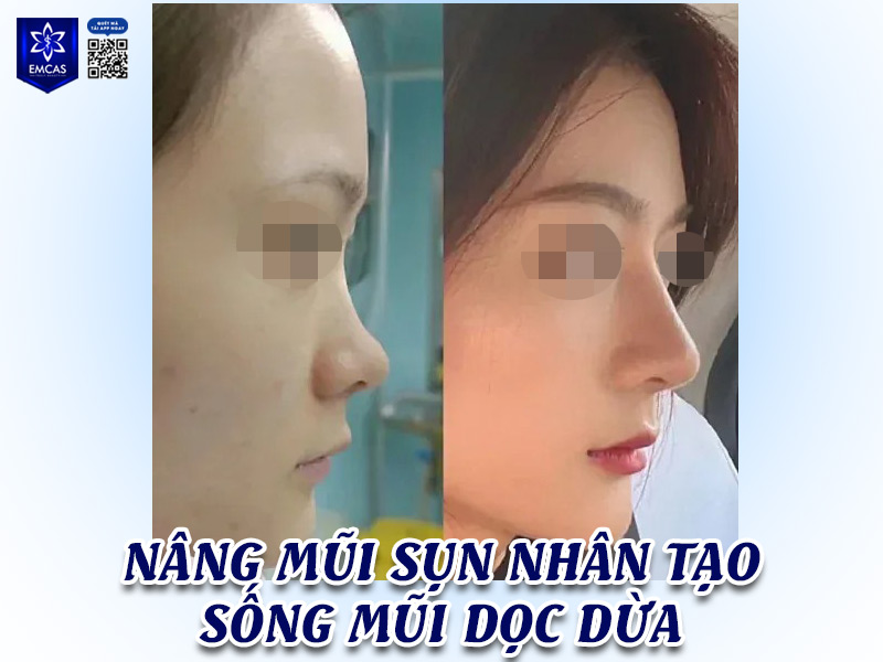 Hiện nay có nhiều công nghệ nâng mũi phong thủy hiện đại để giúp dáng mũi trở nên hài hòa, cân đối và hợp tướng