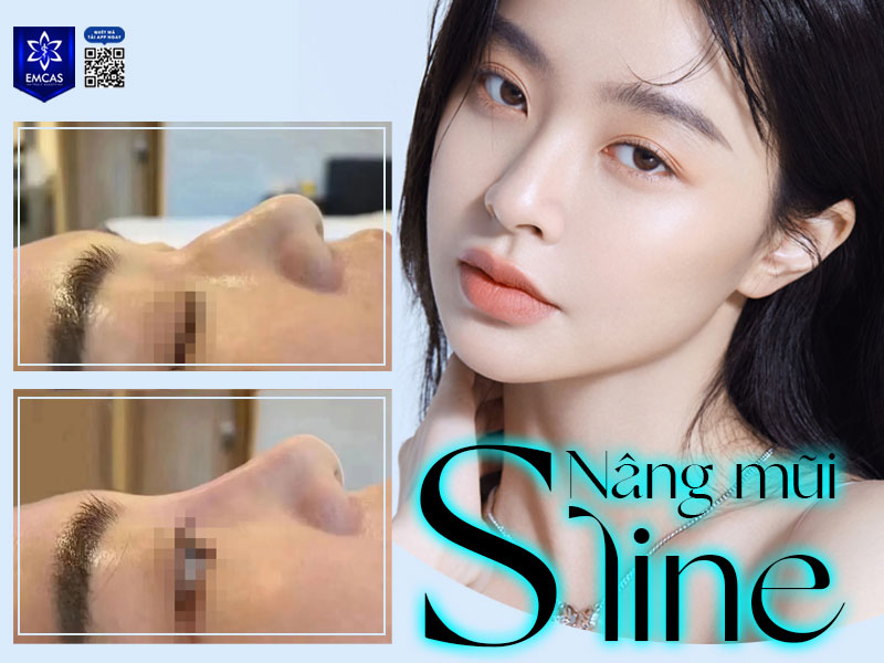 Dáng mũi S Line là dáng mũi có đường cong hình chữ S từ trán kéo dài đến chân mũi