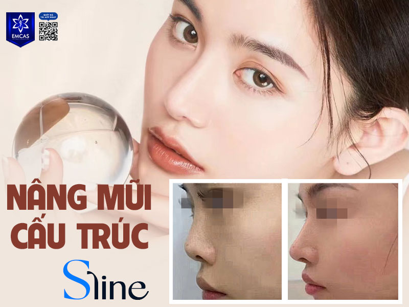 Nâng mũi cấu trúc S Line là phương pháp thẩm mỹ sử dụng sụn nhân tạo kết hợp với sụn tự thân