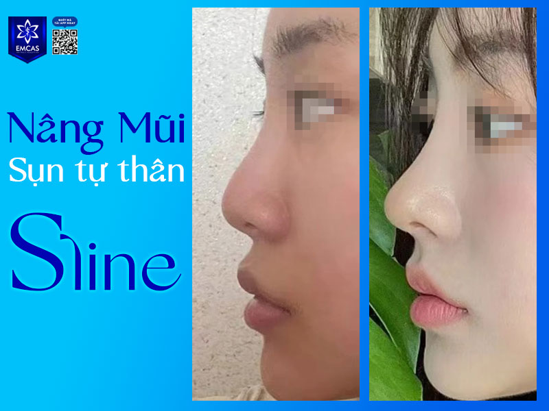 Nâng mũi S Line sụn tự thân hoàn toàn sử dụng 100% vật liệu đến từ chính cơ thể bạn