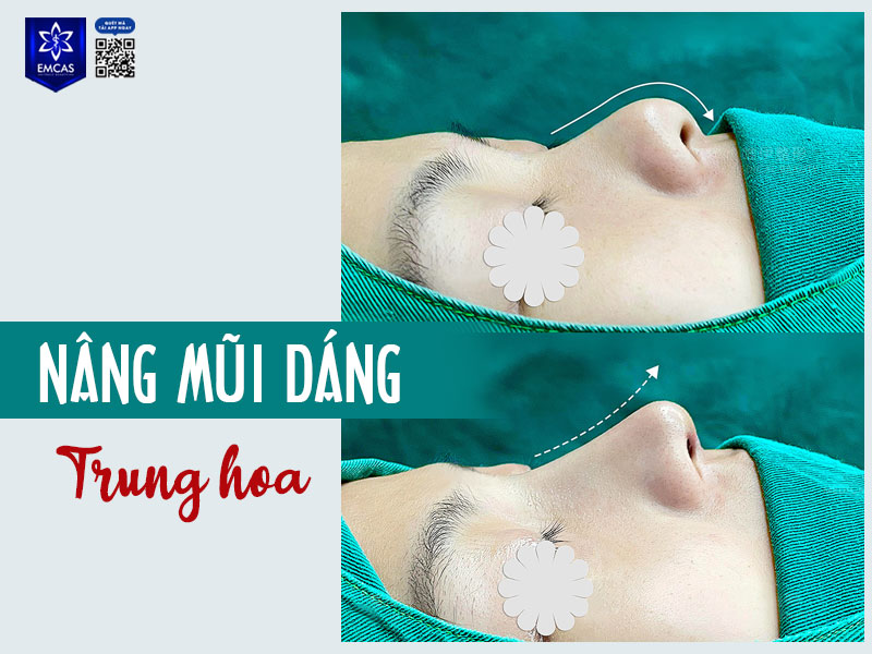 Dáng mũi Trung Hoa được thiết kế để hài hòa với gương mặt của người
