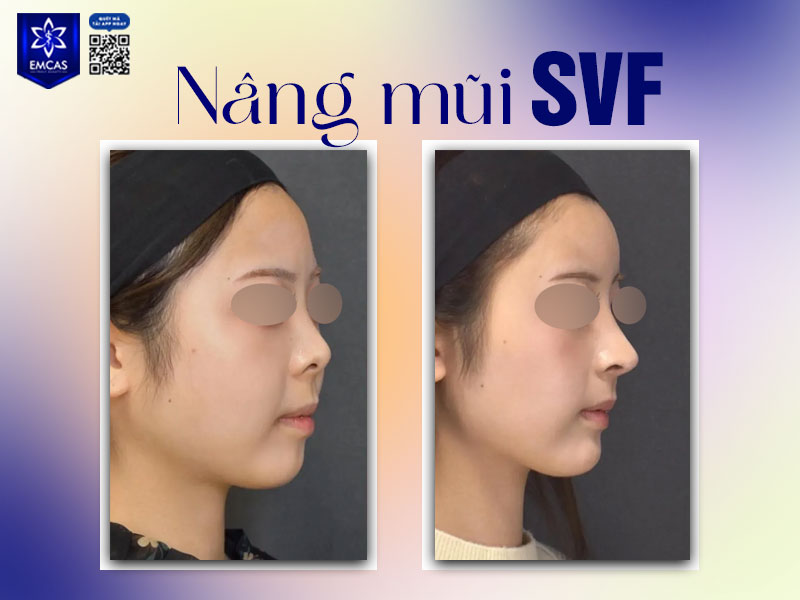 Kẹp nâng mũi chỉ là biện pháp “đánh lừa thị giác” tạm thời, trong khi các phương pháp y khoa được cá nhân hóa mới mang lại hiệu quả thật sự.