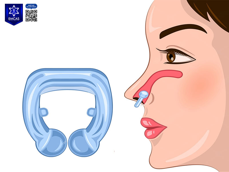 Kẹp nâng mũi là một loại dụng cụ định hình mũi tạm thời, thường được làm bằng nhựa dẻo hoặc silicone mềm, có thiết kế ôm sát sống mũi và cánh mũi.