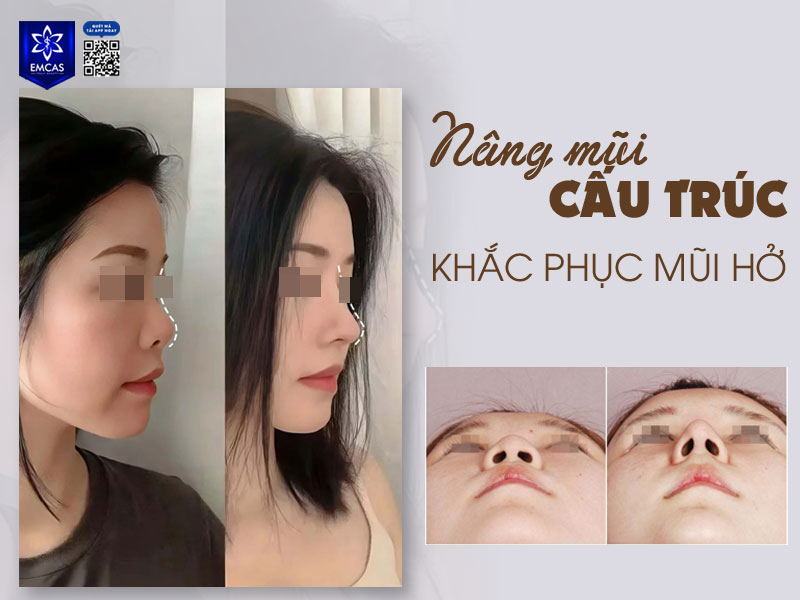Để khắc phục lỗ mũi hở hiệu quả, phương pháp phổ biến và an toàn hiện nay là phẫu thuật chỉnh hình mũi, nâng mũi kết hợp tạo hình cánh mũi.