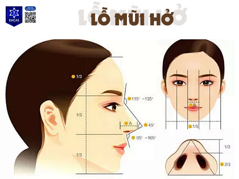 Lỗ mũi hở là tình trạng có thể nhìn thấy rõ phần bên trong lỗ mũi, do trục mũi và vòm cánh mũi có độ mở lớn hơn bình thường