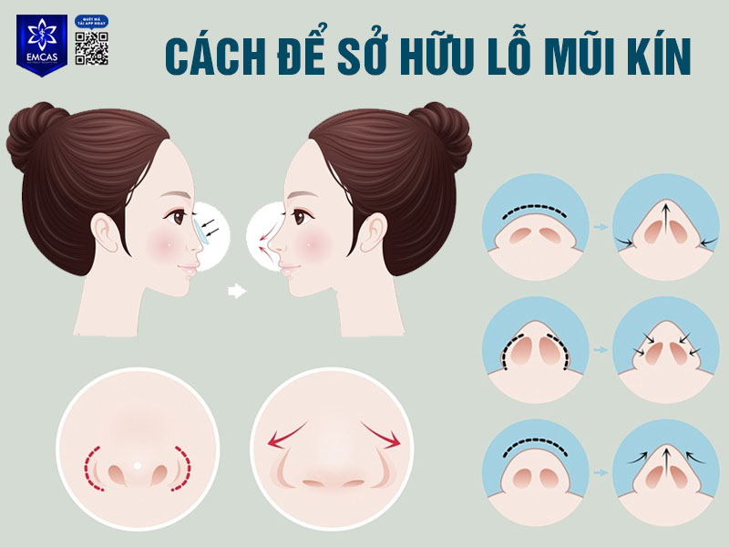 Với sự phát triển của công nghệ thẩm mỹ hiện đại, việc can thiệp để tạo hình lỗ mũi kín giờ đây đã trở nên an toàn và phổ biến
