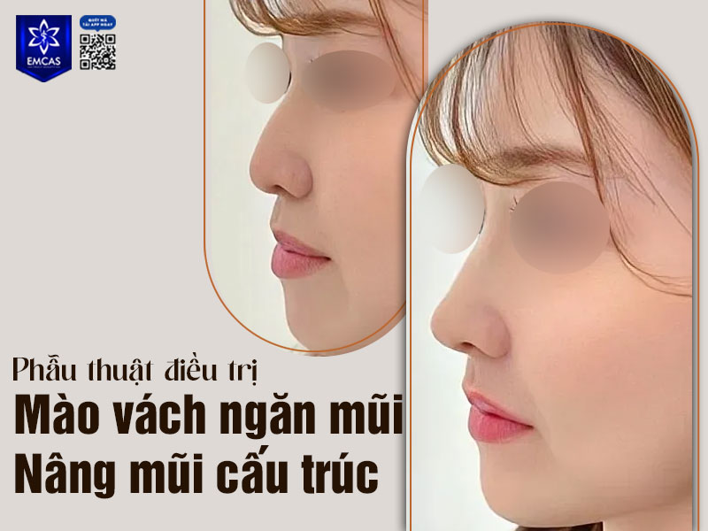 Phẫu thuật nội soi vách ngăn nhằm loại bỏ hoặc chỉnh hình phần mào, tái tạo lại trục thở để cải thiện thông khí.