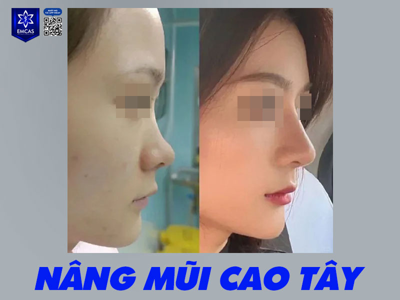 Với đặc trưng là sống mũi cao và thẳng, đầu mũi nhỏ, cánh mũi gọn, kiểu mũi Tây giúp khuôn mặt trở nên thanh thoát, tôn lên các đường nét cá tính