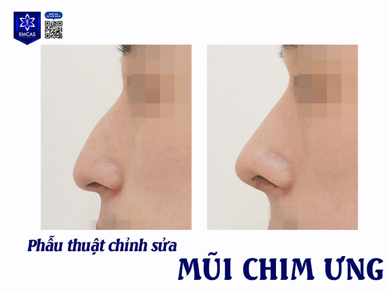 Ở góc độ thẩm mỹ hiện đại, mũi chim ưng không được đánh giá cao về mặt cân đối tổng thể khuôn mặt