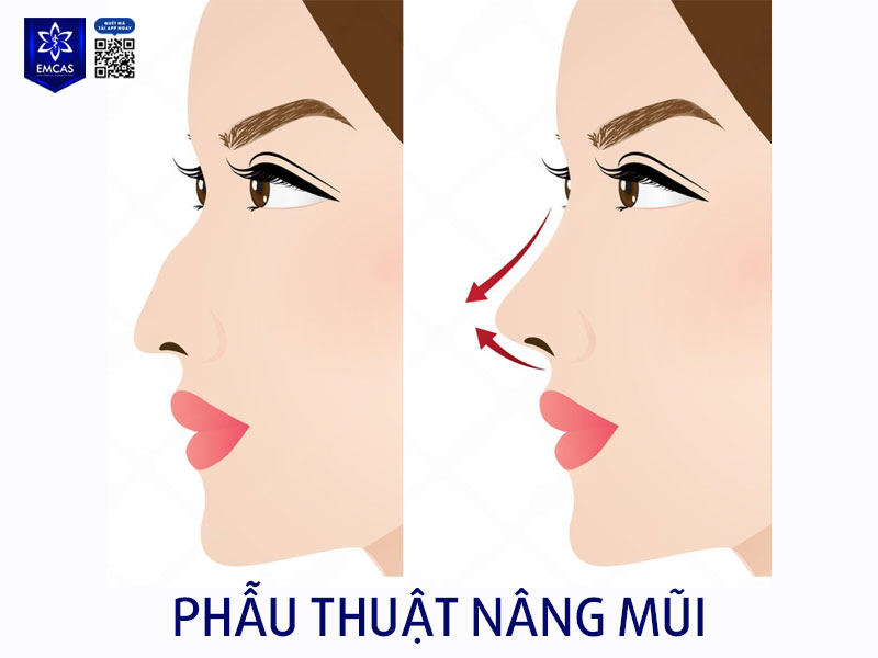 Tại Bệnh Viện Thẩm Mỹ EMCAS, mỗi trường hợp cải thiện mũi con két đều được phân tích riêng