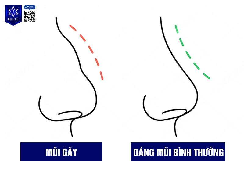 Mũi gãy tức là dáng mũi có phần sống bị đứt đoạn, gấp khúc không còn đường cong thẳng tự nhiên từ gốc mũi đến đầu mũi