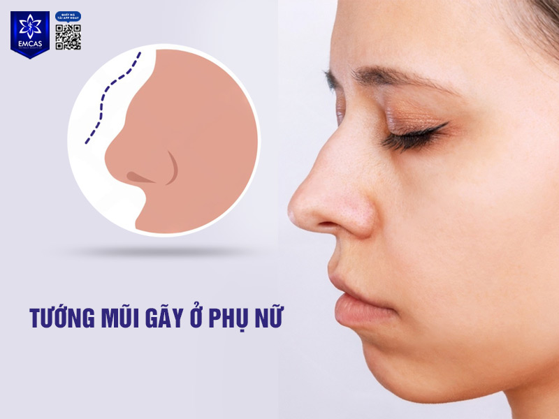Nữ giới có mũi gãy thường gặp khó khăn trong chuyện tình cảm, kết hôn trắc trở, không được suôn sẻ hoặc không được bạn đời thấu hiểu, nâng đỡ
