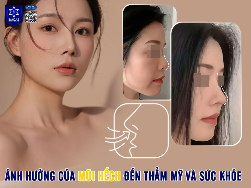 Mũi hếch không chỉ gây ảnh hưởng đến sự hài hòa của gương mặt mà còn có thể tác động đến chức năng sinh lý của mũi – đặc biệt khi mức độ hếch quá rõ hoặc xuất hiện sau chấn thương, phẫu thuật lỗi