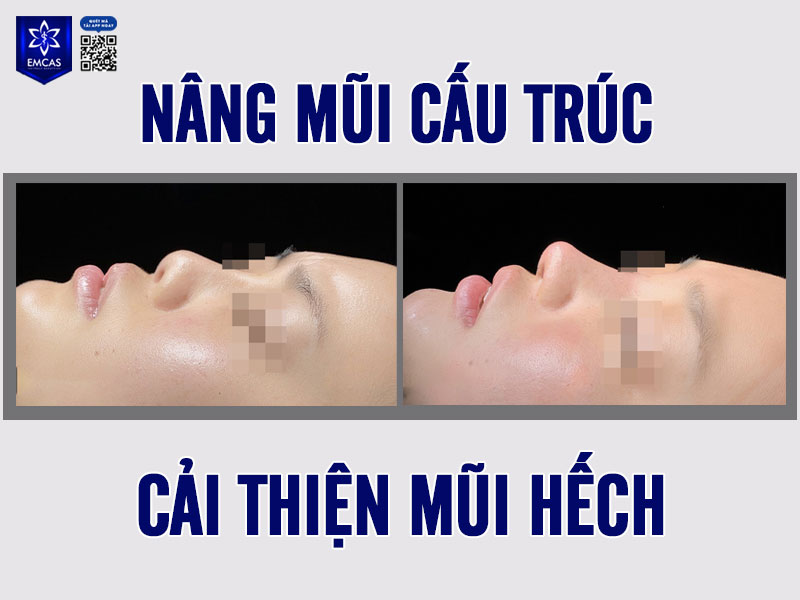 Việc sửa mũi hếch là hoàn toàn nên cân nhắc, đặc biệt với những ai mong muốn cải thiện diện mạo, tăng sự tự tin và hài hòa tổng thể khuôn mặt
