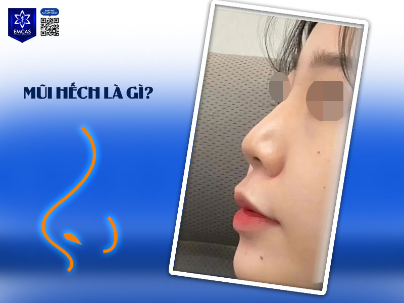 Mũi hếch là dáng mũi có phần đầu mũi ngắn, chếch lên trên, để lộ nhiều lỗ mũi khi nhìn chính diện