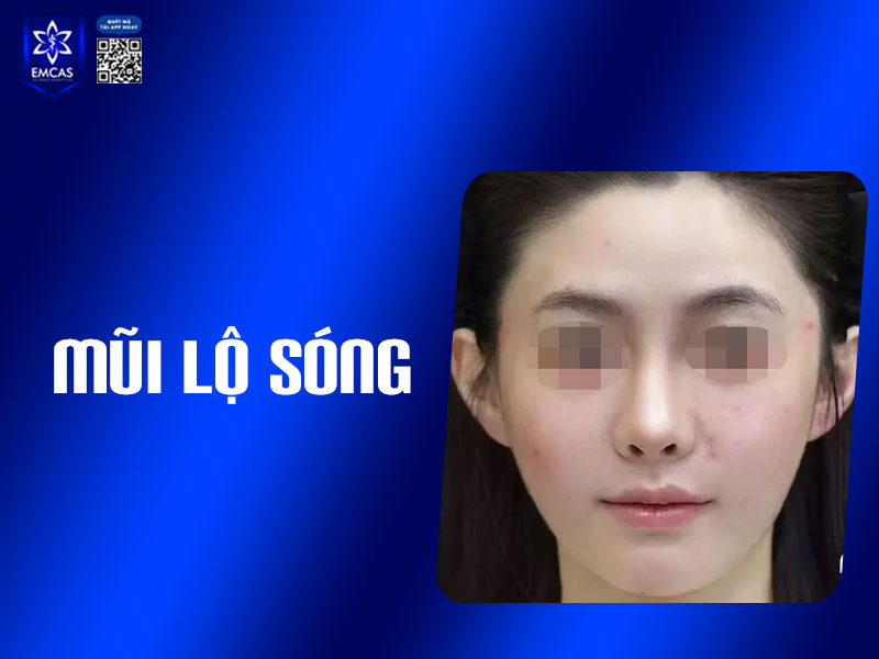 Mũi bị lộ sóng là tình trạng sóng mũi sau nâng không còn giữ được sự thanh thoát, tự nhiên mà thay vào đó là cảm giác cứng, gồ ghề và có thể nhìn thấy rõ đường viền của sụn bên dưới da.