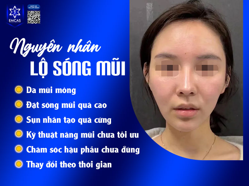 Da mũi mỏng, ít mô đệm thường khó che phủ vật liệu nâng khiến đường viền sụn dễ lộ ra ngoài.