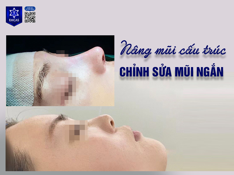 Cách khắc phục mũi ngắn an toàn, hiệu quả ngày nay được nhiều người lựa chọn đó là can thiệp phẫu thuật thẩm mỹ
