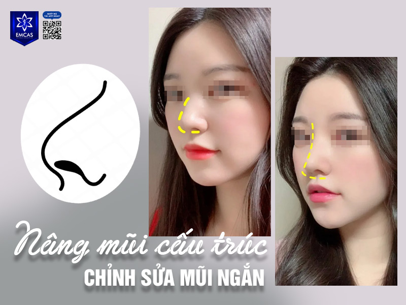 Một chiếc mũi ngắn với chiều dài không đạt tiêu chuẩn thường khiến khuôn mặt trở nên mất cân đối, thiếu đi sự hài hòa, thanh thoát