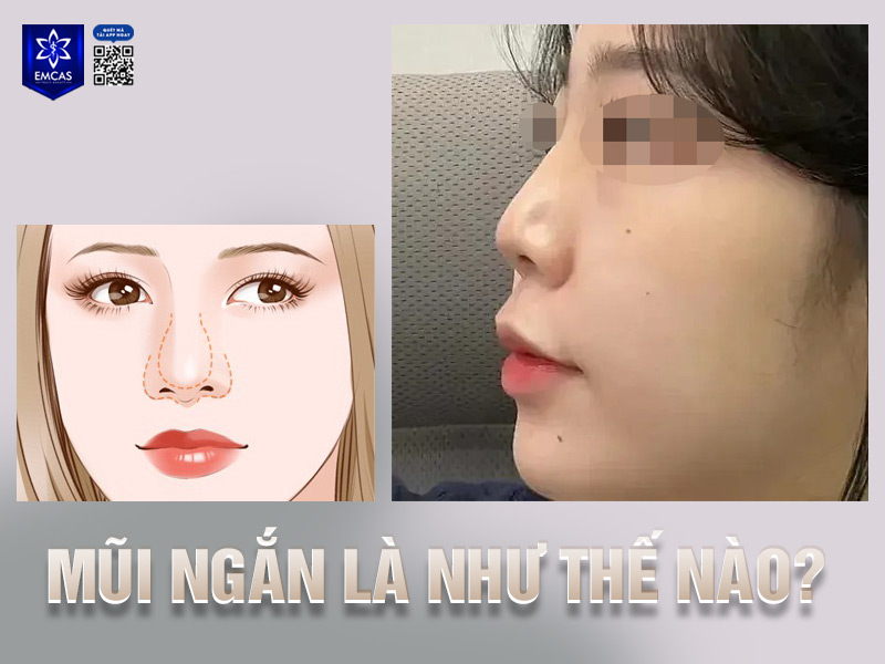Mũi ngắn là dáng mũi có chiều dài từ chân mũi đến đầu mũi ngắn hơn tỷ lệ tiêu chuẩn