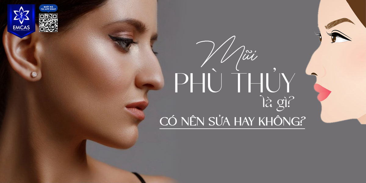 MŨI PHÙ THỦY LÀ GÌ? CÓ NÊN SỬA HAY KHÔNG?