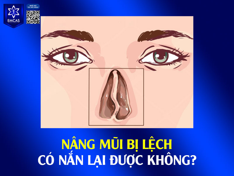 Việc nắn lại sống mũi bị lệch hoàn toàn có thể thực hiện được nhưng mức độ và hiệu quả còn tùy vào nguyên nhân, thời điểm phát hiện và tình trạng lệch cụ thể.