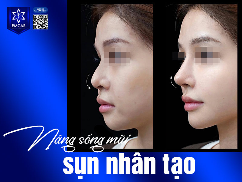 Việc bổ sung đúng loại thực phẩm không chỉ giúp vết thương nhanh khép miệng, mà còn góp phần duy trì dáng mũi đẹp, tự nhiên và ổn định lâu dài.