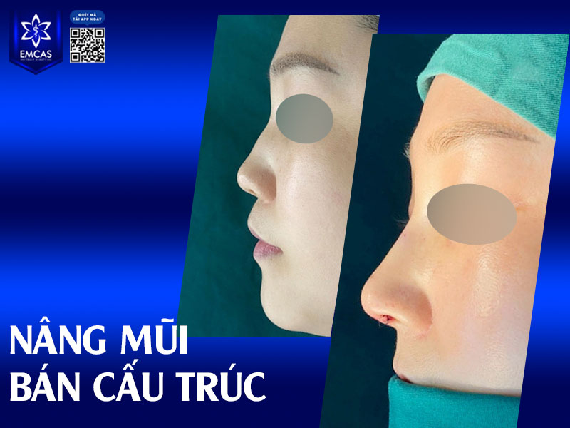 Nếu được thực hiện bởi bác sĩ có chuyên môn cao và chăm sóc hậu phẫu đúng cách, nâng mũi bán cấu trúc có thể duy trì hiệu quả thẩm mỹ trong khoảng 10 – 15 năm.