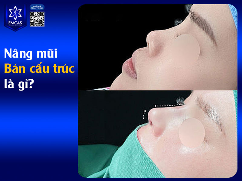 Nâng mũi bán cấu trúc giúp khắc phục các khuyết điểm như mũi thấp, đầu mũi ngắn, mũi lệch nhẹ, đồng thời vẫn giữ lại phần cấu trúc mũi nguyên bản.