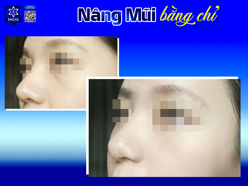 Chăm sóc sau khi nâng mũi bằng chỉ là bước quan trọng ảnh hưởng đến hiệu quả cũng như độ bền của dáng mũi