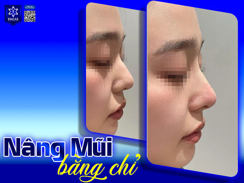Nâng mũi bằng chỉ không phù hợp với người có nhiều khuyết điểm ở mũi và mong muốn cải thiện cấu trúc mũi