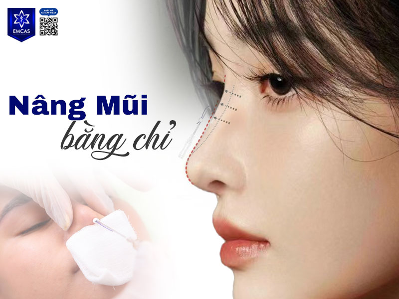 Nâng mũi bằng chỉ là một thủ thuật thẩm mỹ không có sự can thiệp dao kéo, ít xâm lấn và có tính an toàn cao được nhiều người ưa chuộng thực hiện.