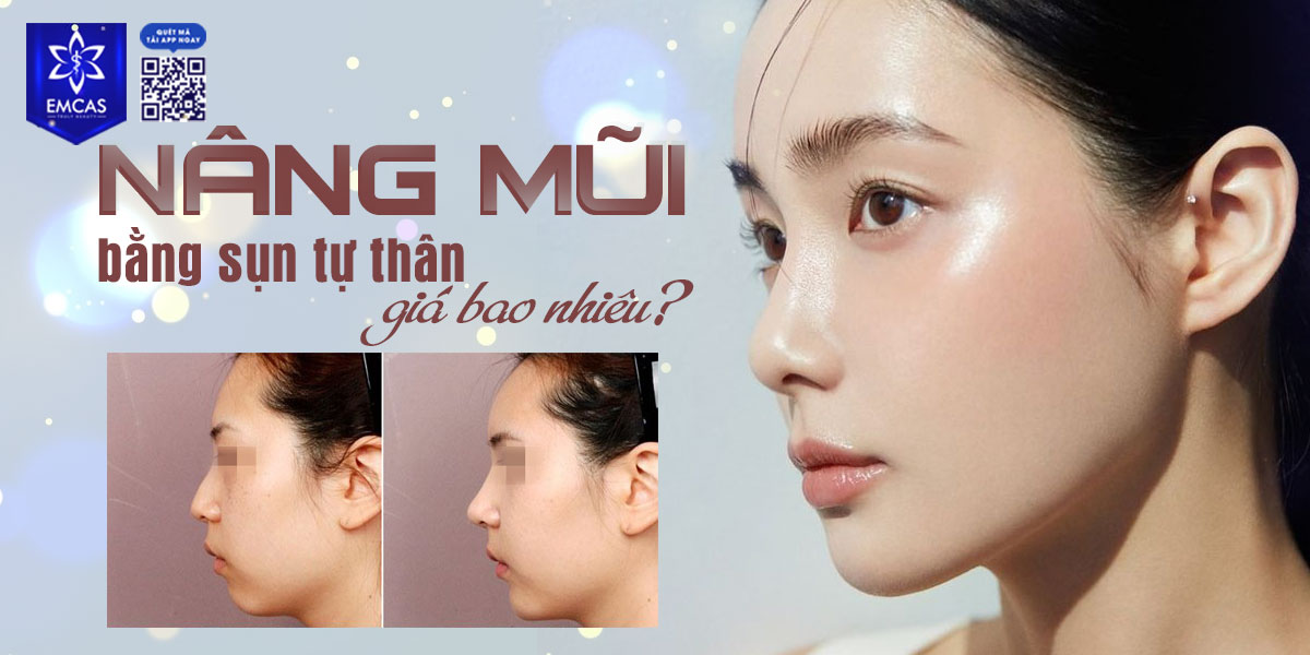 Nâng Mũi Bằng Sụn Tự Thân Giá Bao Nhiêu? Tham Khảo Bảng Giá Tại EMCAS