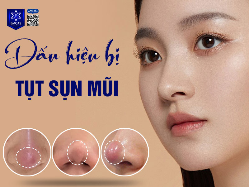 Tụt sụn mũi không chỉ làm mất đi tính thẩm mỹ của dáng mũi mà còn tiềm ẩn nhiều nguy cơ về sức khỏe nếu không được phát hiện và xử lý kịp thời