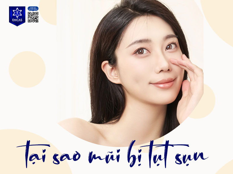 Tụt sụn mũi là biến chứng không hiếm gặp sau nâng mũi, đặc biệt ở những ca sử dụng vật liệu nâng không phù hợp hoặc thực hiện tại các cơ sở thiếu chuyên môn.