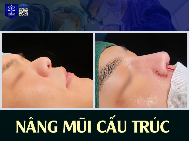 Cảm giác khi cắt chỉ chỉ là châm chích nhẹ tại vùng khâu và nhanh chóng hết sau vài phút, hoàn toàn nằm trong ngưỡng chịu đựng bình thường.