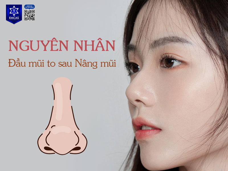 Đầu mũi sưng, căng và to sau nâng mũi là hiện tượng bình thường do mô mềm bị tổn thương và phản ứng sưng viêm sau can thiệp