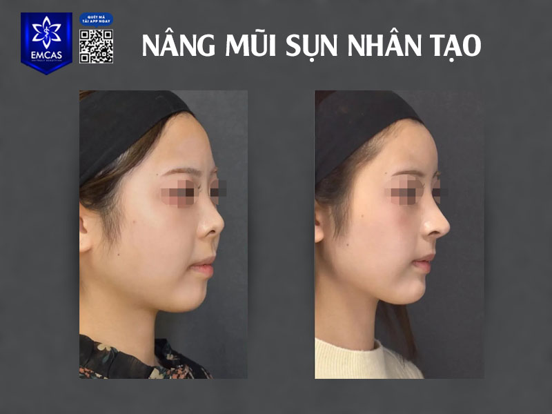 Vệ sinh da mặt đúng cách nhằm giúp giảm nguy cơ nhiễm trùng, hạn chế sẹo và hỗ trợ quá trình hồi phục nhanh chóng sau nâng mũi.
