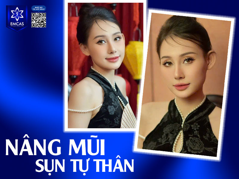 10 ngày đầu tiên sau phẫu thuật nâng mũi là giai đoạn có sự ảnh hưởng lớn đến kết quả hồi phục và dáng mũi về sau.