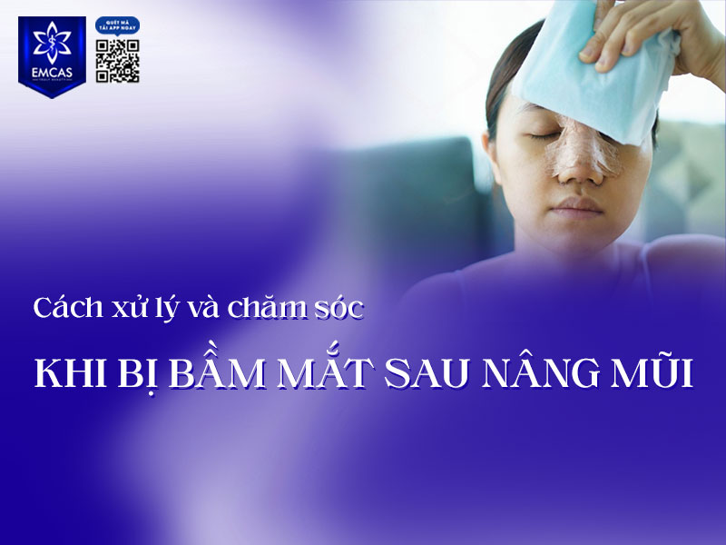 Việc nắm rõ cách xử lý và chăm sóc khi bị bầm mắt sau nâng mũi sẽ giúp bạn giảm sưng tím nhanh hơn, đồng thời hỗ trợ mũi vào form đẹp, ổn định và an toàn hơn trong giai đoạn hậu phẫu.