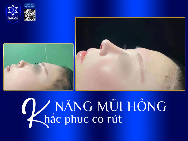 Thông thường, nâng mũi bị co rút sẽ không xảy ra ngay sau khi phẫu thuật mà xuất hiện dần theo thời gian khi mô sẹo co kéo hoặc sụn không tương thích với cơ thể.